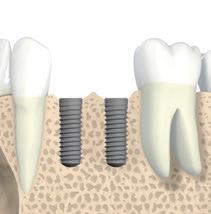 3.1.1.2 Exemplos para a ausência de vários elementos dentários Os seguintes exemplos mostram a forma de implementação das regras 1 e 2 quando se trata da ausência de vários elementos dentários.