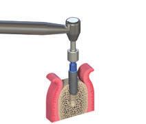 3 3 Passo 3 Inserção do implante Insira o implante, utilizando o contra-ângulo, no local de implantação.