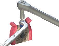 Durante as primeiras rotações, segure o implante com a chave de retenção usada para estabilizar (segurar) o sextavado.