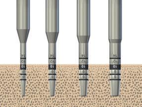 6.2 Osteótomos 6.2.1 Conjunto de instrumentos para condensação óssea Indicados em casos de osso esponjoso (classes de osso 3 e 4).