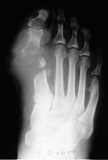 Entretanto, os achados ósseos usualmente são observados somente de uma a duas semanas após o início do quadro clínico, pois é necessário que pelo menos 50% do osso seja perdido para que as alterações