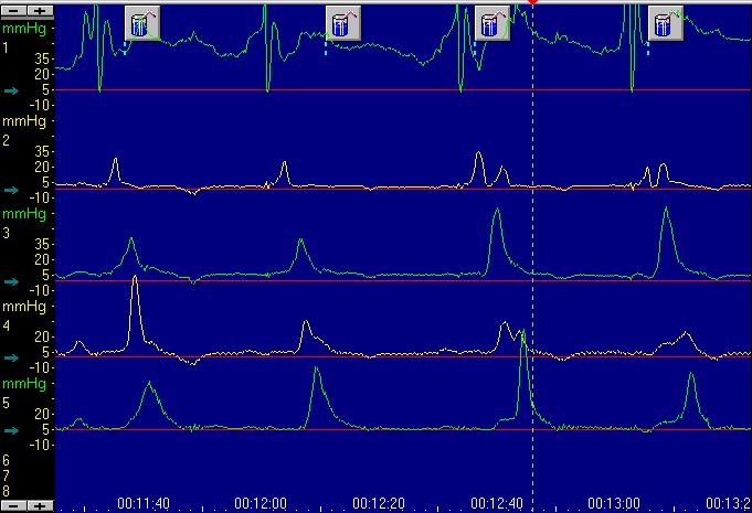Métodos 24 18 cm acima do EIE 3 cm acima do EIE FIGURA 5 - Gráfico demonstrando a avaliação do peristaltismo esofágico e a medida da amplitude de contração dos complexos de deglutição realizados a 3