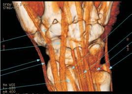 Clínicos e cirurgiões apresentam maior facilidade de compreender as lesões do antebraço e mão mediante reformatações de tomografia computadorizada e, com isso, realizam o tratamento clínico ou a