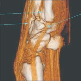 Mecanismo Extensor da Mão: Desvendando a Anatomia e Avaliação por Métodos de Imagem 0 Figura Cortes axiais de ressonância magnética do punho.. Abdutor longo do polegar;. Extensor curto do polegar;.