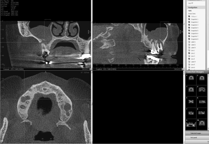 INTRODUÇÃO Os seios maxilares são sítios frequentes de patologias de origem odontogênica.