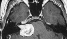 PAN (POSITIONAL ALCOOL NYSTAGMUS) Aparece 30 minutos após a ingestão de álcool, e é desencadeada pela rotação lateral da cabeça em supino.