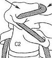 COLUNA CERVICAL E VERTIGEM - ARTERIA VERTEBRO BASILAR O papel da coluna cervical e musculatura do pescoço é relevante em relação a patologia do equilíbrio.