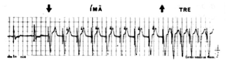 mulação ventricular assíncrona) na frequência programada ou magnética.