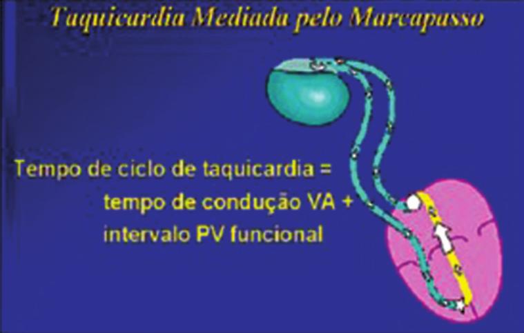 critas acima, e, desse modo, impossibilitar uma nova estimulação ventricular.