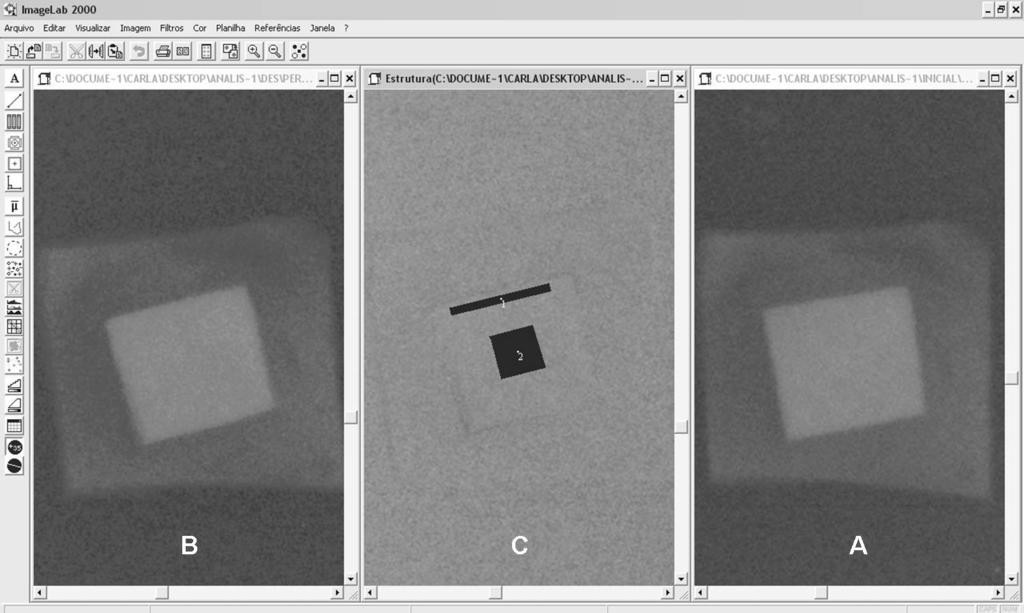 Figura 2 Subtração radiográfica. A: Imagem inicial; B: Imagem Desmineralizado; C: Sobreposição das imagens e seleção das áreas teste e controle.