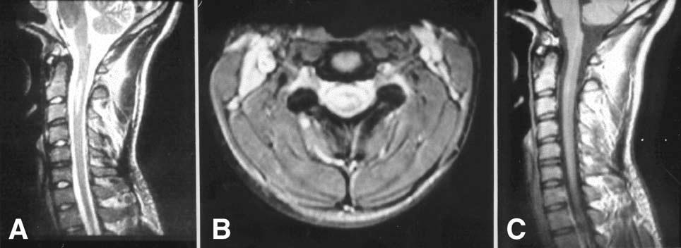 22 Quando comparada a tomografia computadorizada, a ressonância magnética apresenta vantagem por haver a possibilidade de realizar cortes coronais e sagitais, sendo considerada por MINGUETTI, (2001),