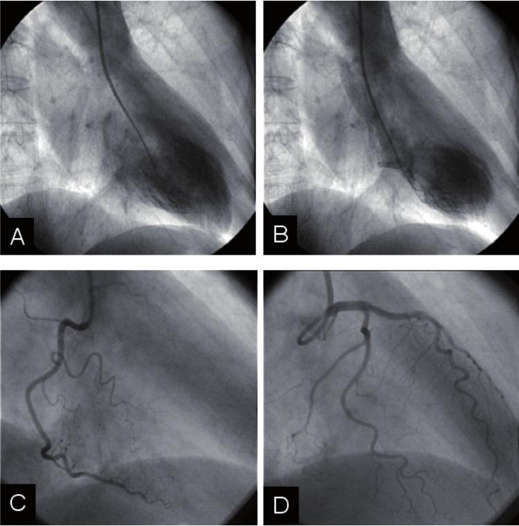 Fig. 4 - Imagens cineangiográficas de contraste radiológico durante cateterismo cardíaco realizado no quarto dia de evolução.