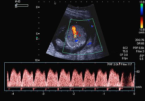 44 Métodos mostra um exemplo de imagem ultrassonográfica da dopplervelocimetria do ducto venoso com efeito de mistura de cores. Figura 3 