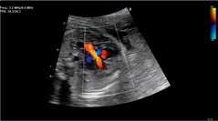 Ecocardiografia com Doppler colorido em adulto A tecnologia do transdutor XDclear oferece a