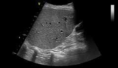 Imagem abdominal Imagem abdominal do transdutor C1-5-D com harmônica oferece excelente resolução