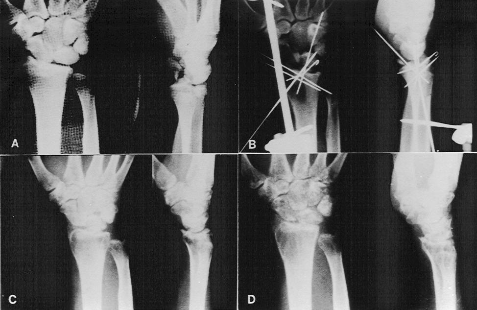 Figura 2: Seqüência radiográfica de um paciente submetido à redução aberta, clinicamente bem à época da reavaliação: A) radiografias pré-operatórias, mostrando subluxação volar do carpo; B) controle