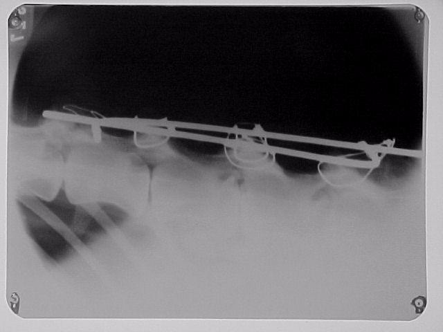 )D Figura 3. Imagem radiográfica de coluna lombar de uma onça parda, macho (Puma concolor) de 14 anos de idade, após correção cirúrgica. Vista latero lateral.