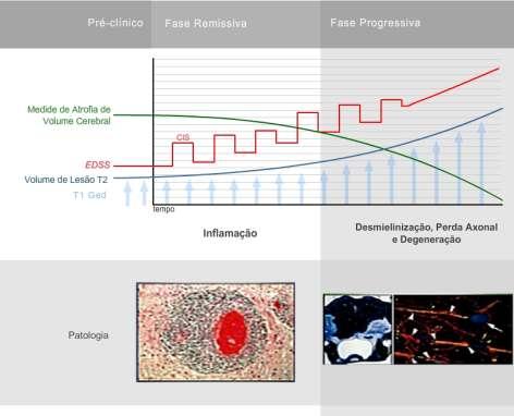 pré-clínico Recorrente-remitente Progressiva