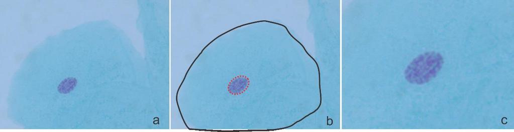 26 Cromatina condensada Figura 4 - (a) Imagem da célula da mucosa bucal com cromatina condensada de