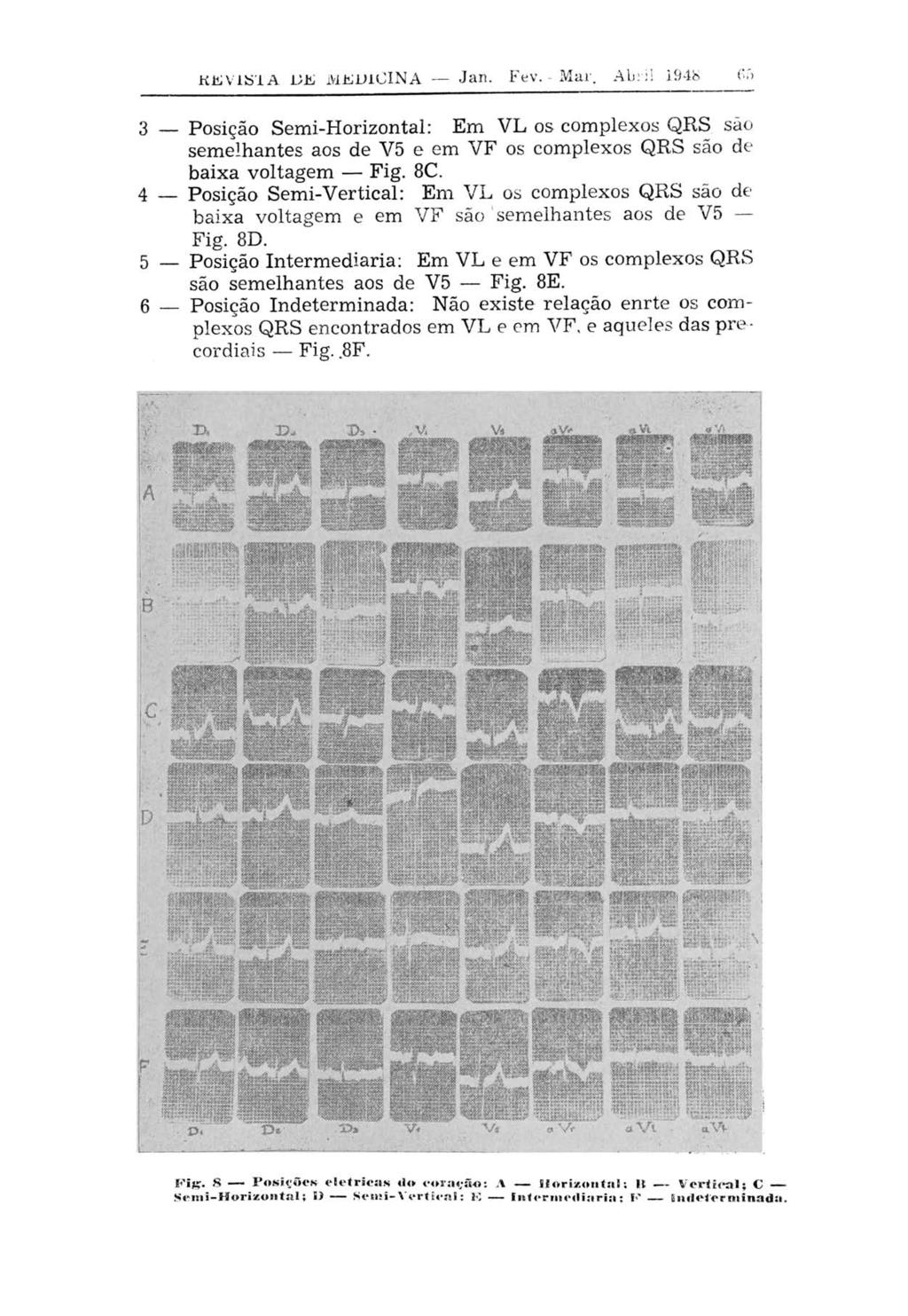 KEVÜSTA LE MEDICINA Jan. Fev. - Mar. Abril 1948 (v> Posição Semi-Horizontal: Em VL os complexos QRS são semelhantes aos de V5 e em VF os complexos QRS são de baixa voltagem Fig. 8C.