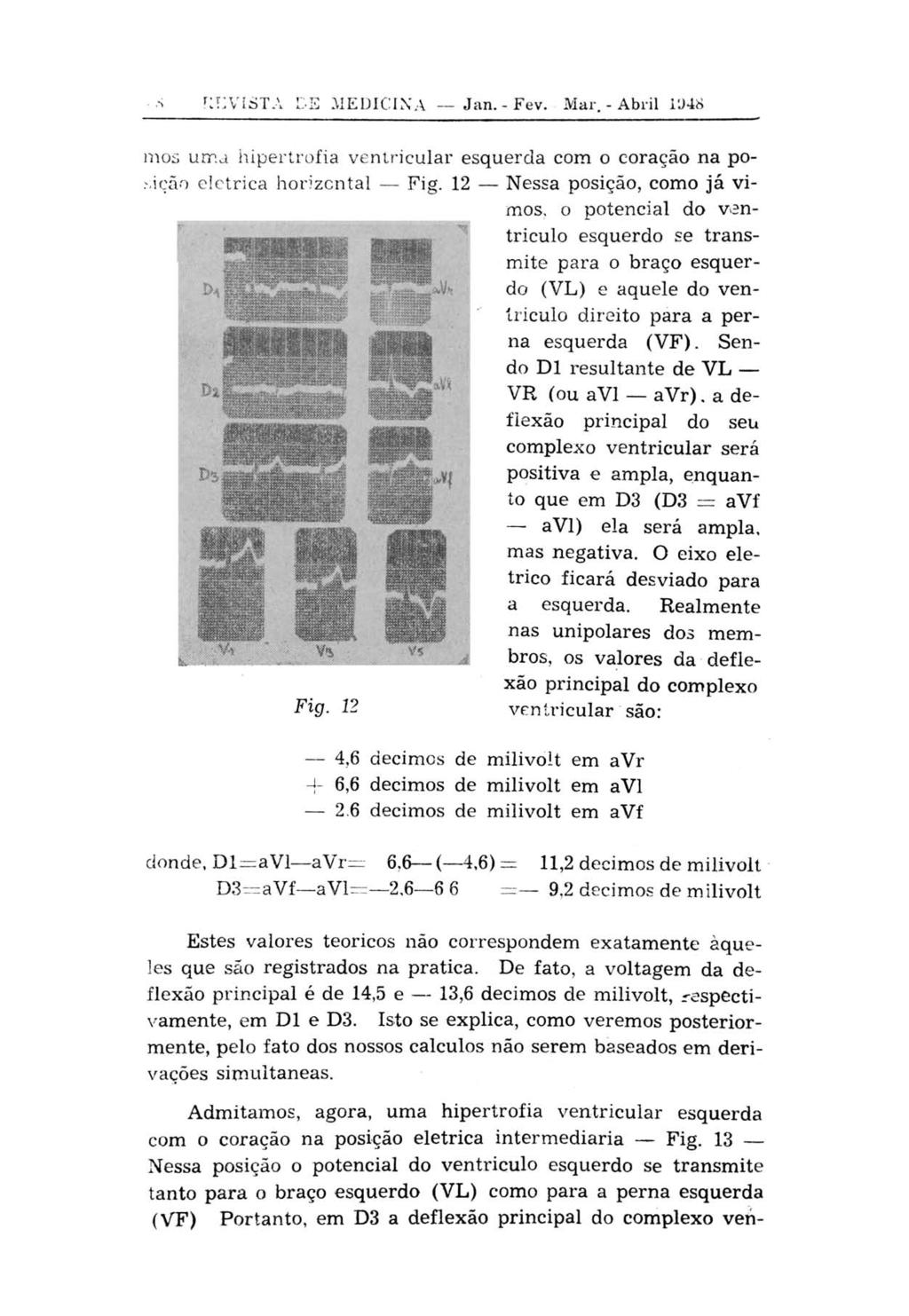 REVISTA DE MEDICINA Jan. - Fev. Mar. - Abril 1948 mos uma hipertrofia ventricular esquerda com o coração na posição elétrica horizontal Fig.