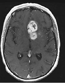 GBM. Na metodologia empregada para testes do sistema de simulação, para cada caso foi selecionado um par de imagens (I 1, I 2 ) as quais capturaram dois estágios da doença (GBM): (I 1 ) no estágio