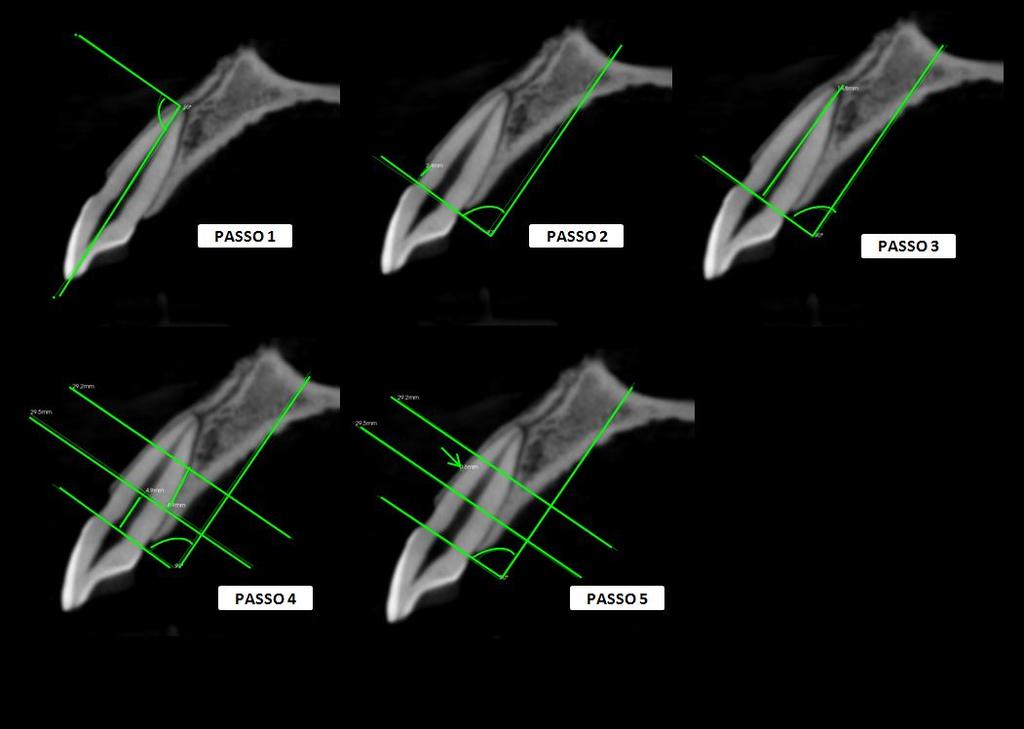 36 Figura 6 - Imagens tomográficas de feixe cônico parassagitais demonstrando a sequência utilizada para mensurar e dividir os terços da raiz.