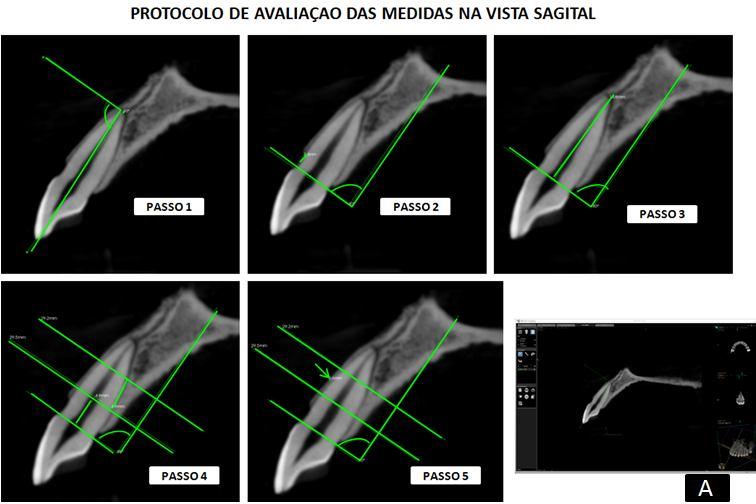 41 Figura 12 A - Protocolo de avaliação das medidas na vista sagital,