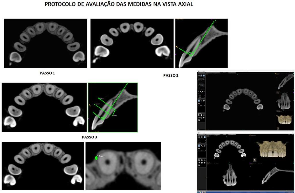 43 Figura 14 - Sequência de imagens axiais e parassagitais respectivas, empregadas na avaliação dos terços: Determinação do longo eixo do dente (Passo 1); Transferência da linha perpendicular ao