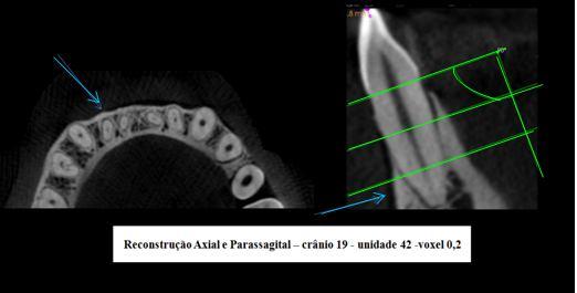 Inicialmente foram feitas as análises utilizando voxel de 0,2mm e, num segundo momento, com voxel de 0,076mm (Figuras 15 e 16), sendo que cada examinador avaliava apenas 01 crânio por dia, com