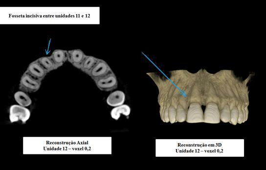 63 Somando-se a isso, procedendo à análise dos cortes axiais das unidades 12 e 22, havia frequentemente uma menor espessura óssea na face MV.
