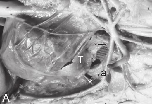 Vascularização arterial dos lobos torácicos do timo em fetos de suínos da Linhagem C40 865 Fig.1. Cavidades torácicas de fetos de suínos da linhagem C40, (A) nos antímeros direito e (B) esquerdo.