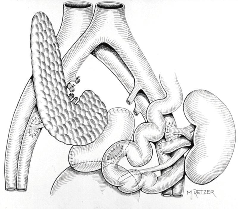 A manutenção da imunossupressão baseia-se na utilização de inibidor de calcineurina (Tacrolimus) associado a um anti-metabólito (micofenolato mofetil) e corticóide (prednisona).