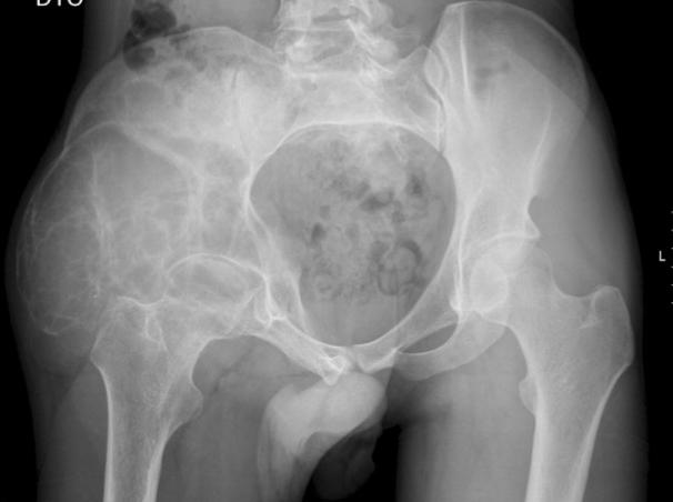 Figura 3 - Embolização arterial seletiva do quisto ósseo aneurismático Figura 4 - Radiografia simples da bacia aos 3 meses pós-embolização demonstrando calcificação da massa aneurismática Figura 5 -