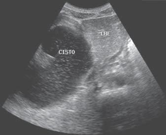 terizada, atingindo então o colédoco ou o ducto pancreático para injetar contraste na via biliar, com documentação radiográfica realizada concomitantemente.