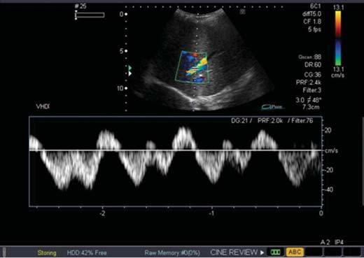 Artérias segmentares A aceleração sistólica inicial foi superior a 3,0 nos exames realizados durante a gravidez e no pós-parto. Litíase renal No primeiro de gravidez não foi observada litíase renal.