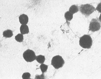 bacterias isoladas) meningite neonatal (estirpe K1) septicemia gastrenterite (5