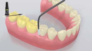 9 Aplicação de Fluor nos Dentes Uma fina camada do Flúor Protector é aplicado com um Vivabrush