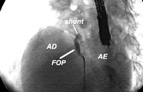 pacientes (3 ASD e 3 PFO) apresentaram shunt residual, com 2 deles evoluindo com embolia recorrente num seguimento cumulativo de 37 anos.