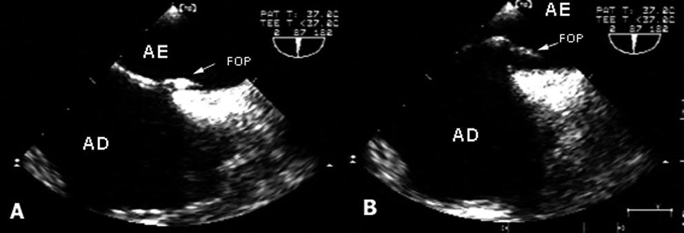 Figura 2 - Em A, visualiza-se o forame oval, podendo-se analisar toda a sua morfologia (comprimento x abertura).