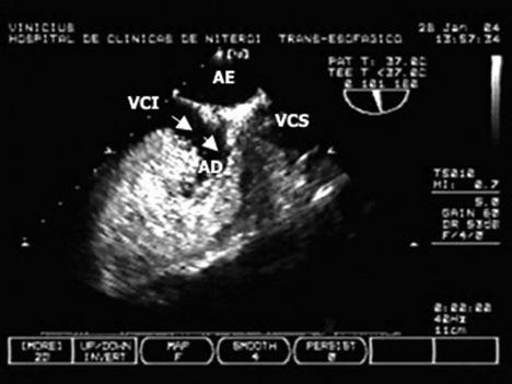 O color Doppler não é capaz de demonstrar com segurança esse fluxo.