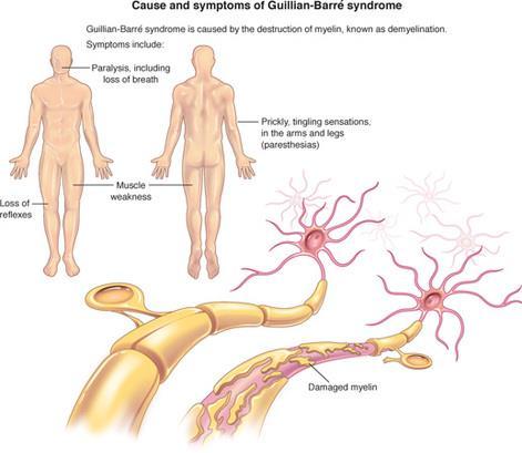 Síndrome de Guillain-Barré polineuropatia aguda de rápida progressão caracterizada por desmielinização dos nervos. Acomete nervos periféricos, raiz e medula.