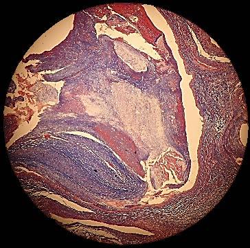 Tricromo de Masson Trombo Venoso Veia trombosada e grande quantidade de