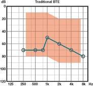 Retroauriculares(BTE): Vantagens Adequado para todos os