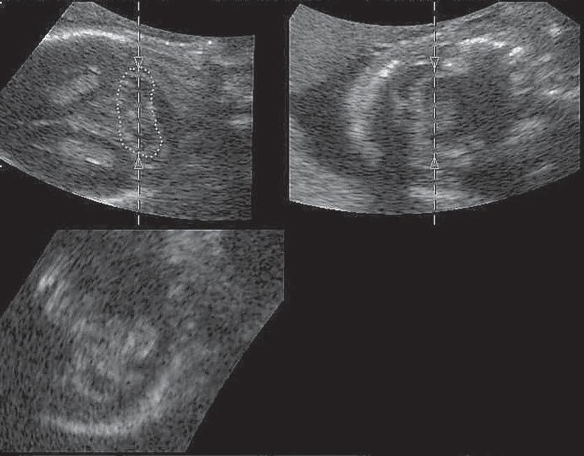 Aplicações da US3D na avaliação do cerebelo fetal Figura 1.