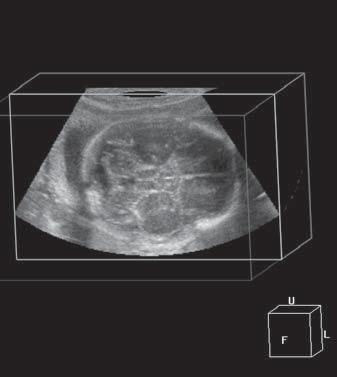 Aplicações da US3D na avaliação do cerebelo fetal Figura 5. Sonograma do crânio fetal em um caso de síndrome de Dandy-Walker. Observa-se o programa VCTV na forma de cubo.
