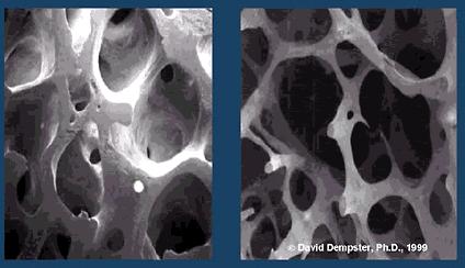 DEFINIÇÃO A Osteoporose é uma doença osteo-metabólica caracterizada pela diminuição da massa