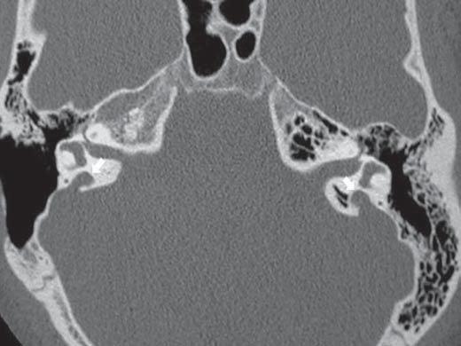 É importante ressaltar, ainda, que esses achados tomográficos não são exclusivos da otosclerose e que outras doenças podem gerar alterações semelhantes, tais como a otossífilis, a osteogênese