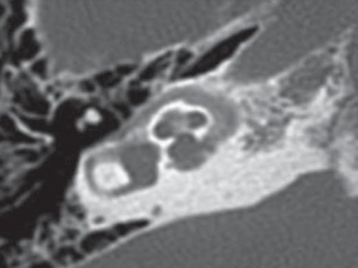 Ainda que a ressonância magnética possa ser útil neste contexto, seu principal papel, atualmente, tem sido a pesquisa do foco ativo, extensão intracanalicular do foco e principalmente a detecção de