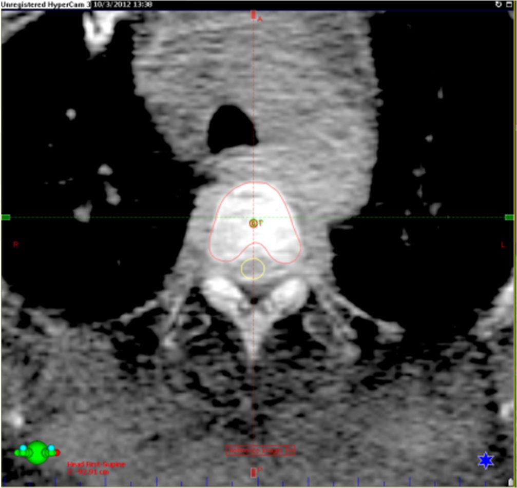 CBCT pós